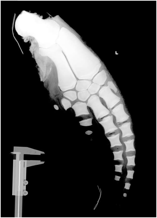 Ein Röntgenbild eines Mannes mit einem Bruch in der Mitte, mit einem Metallband auf der linken Seite, vor schwarzem Hintergrund.