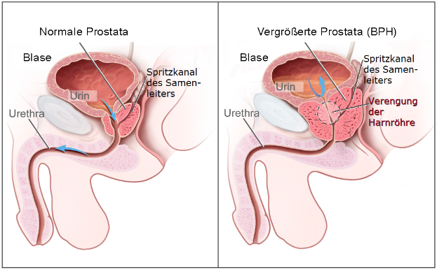 Eine Abbildung der männlichen Geschlechtsorgane mit "Prostata" und "BPH" beschriftet, die die Stadien von Prostatakrebs in verschiedenen Blauschattierungen zeigt.